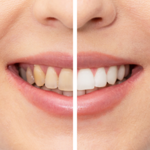 Teeth Whitening at Gate City Dental in Greensboro